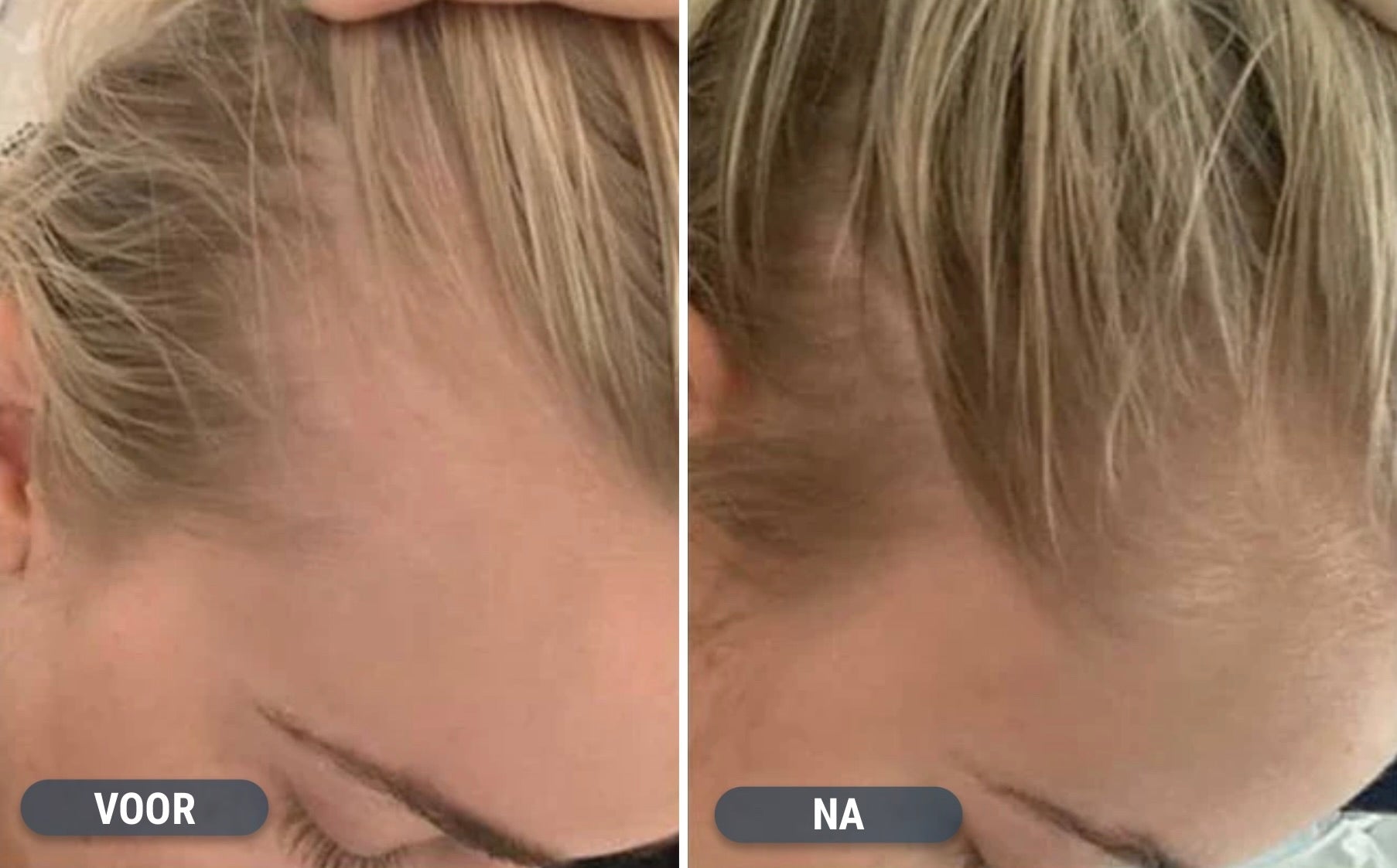 Minoxidil vrouw resultaten